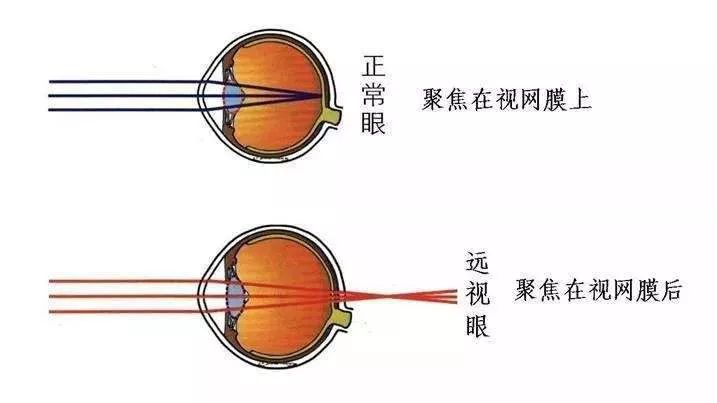 家长须知,孩子有远视需要治疗吗?_远视眼