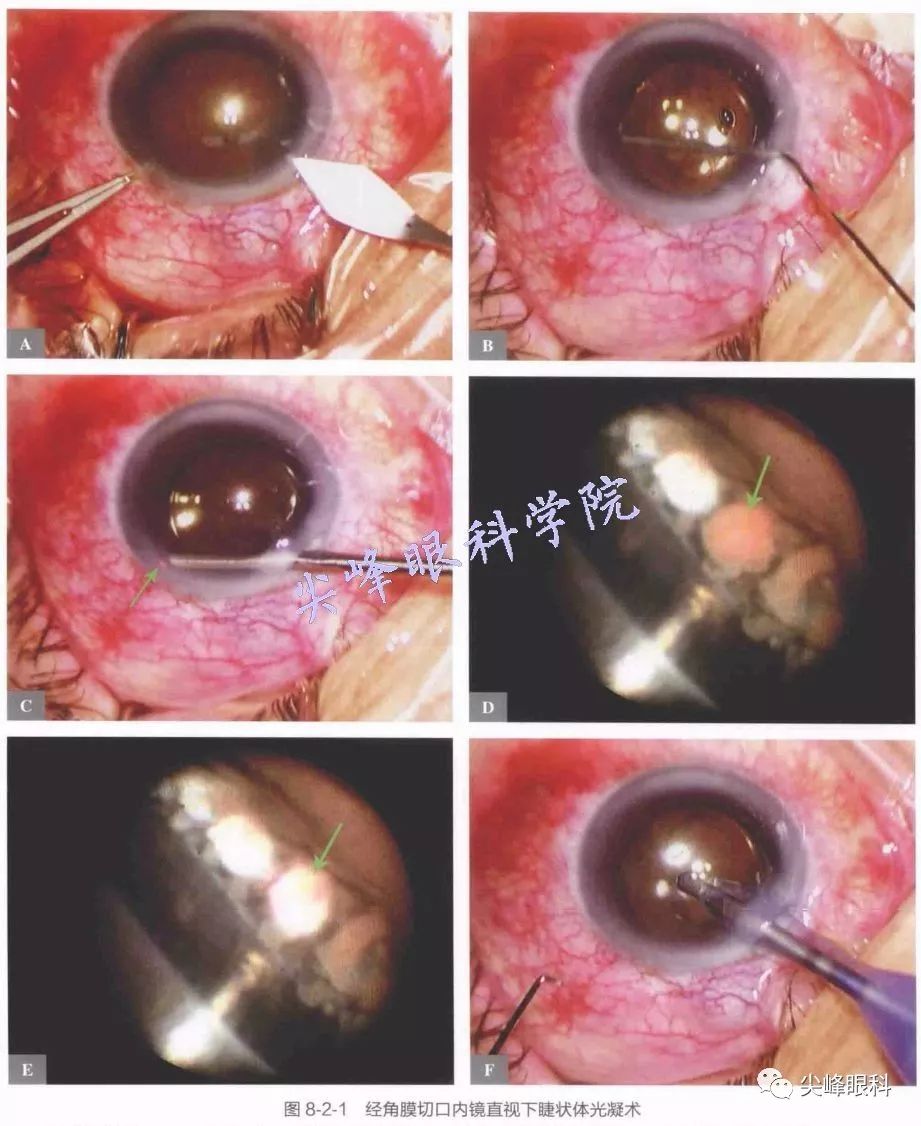 内镜直视下睫状体光凝术part02图解青光眼手术操作与技巧062