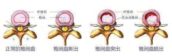 好消息 | 腰椎间盘突出患者的福音! 澳门赌博网址