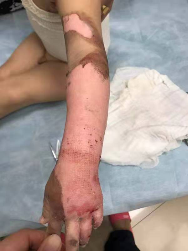                     长春5岁女宝掉进汤锅致重度烫伤  请注意你家的“阙勒霍多”