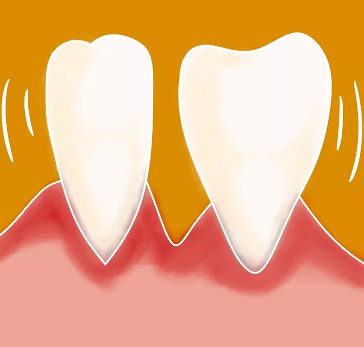 【口腔微学院】洗牙有必要吗?有害吗?难受吗