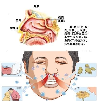 慢性鼻炎总打喷嚏流鼻涕怎么办_治疗