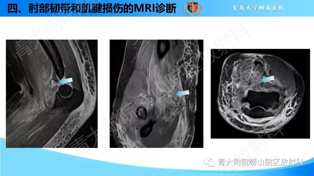 肘部韧带和肌腱损伤的mri诊断