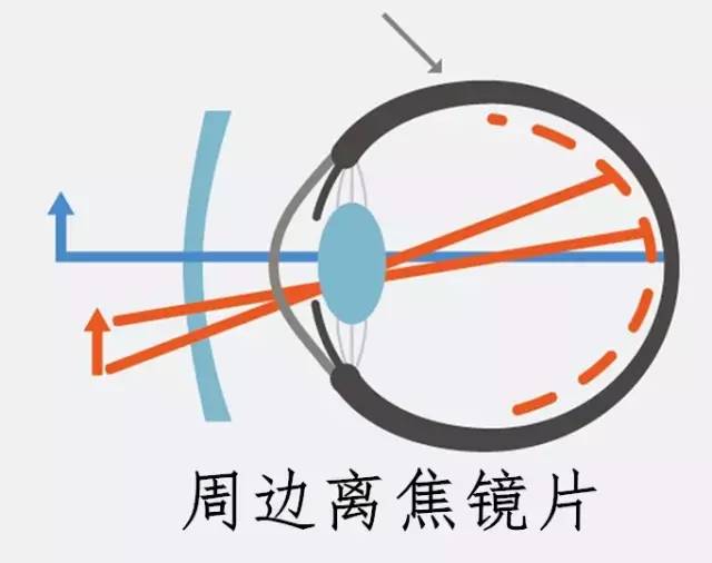 怎样有效控制近视度数增长 edb95eb7472242ca997baae1b6325cde.jpeg