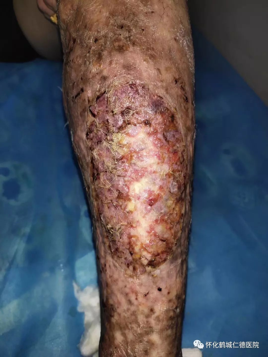 四十年的小腿溃疡快速愈合