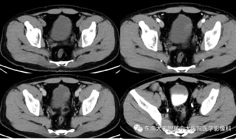 ct 增强 编辑/校对:郑孝飞 病例结果:息肉样腺性膀胱炎 责任编辑