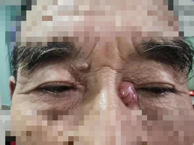 凃惠芳主任表示,最近一两个月门诊接诊了上10例恶性肿瘤的患者,眼睛