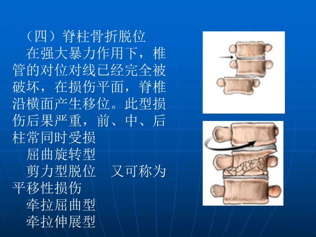 牵拉伸展型(distractive extension) 脊柱受到伸展拉力,前柱张力性