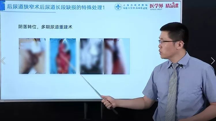 泌尿外科医生的尿道修复重建超实用锦囊