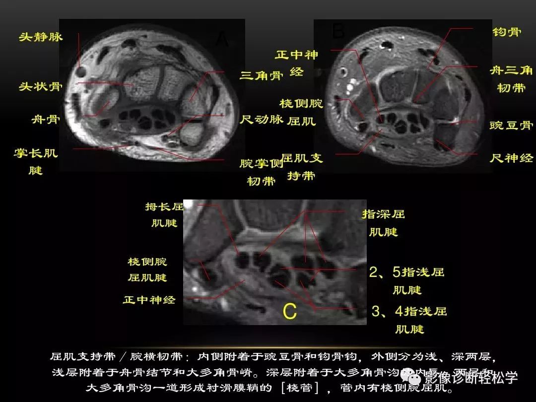 腕关节病变的mri诊断和解剖