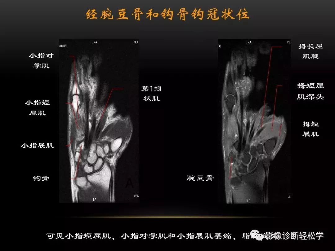 腕关节病变的mri诊断和解剖_影像