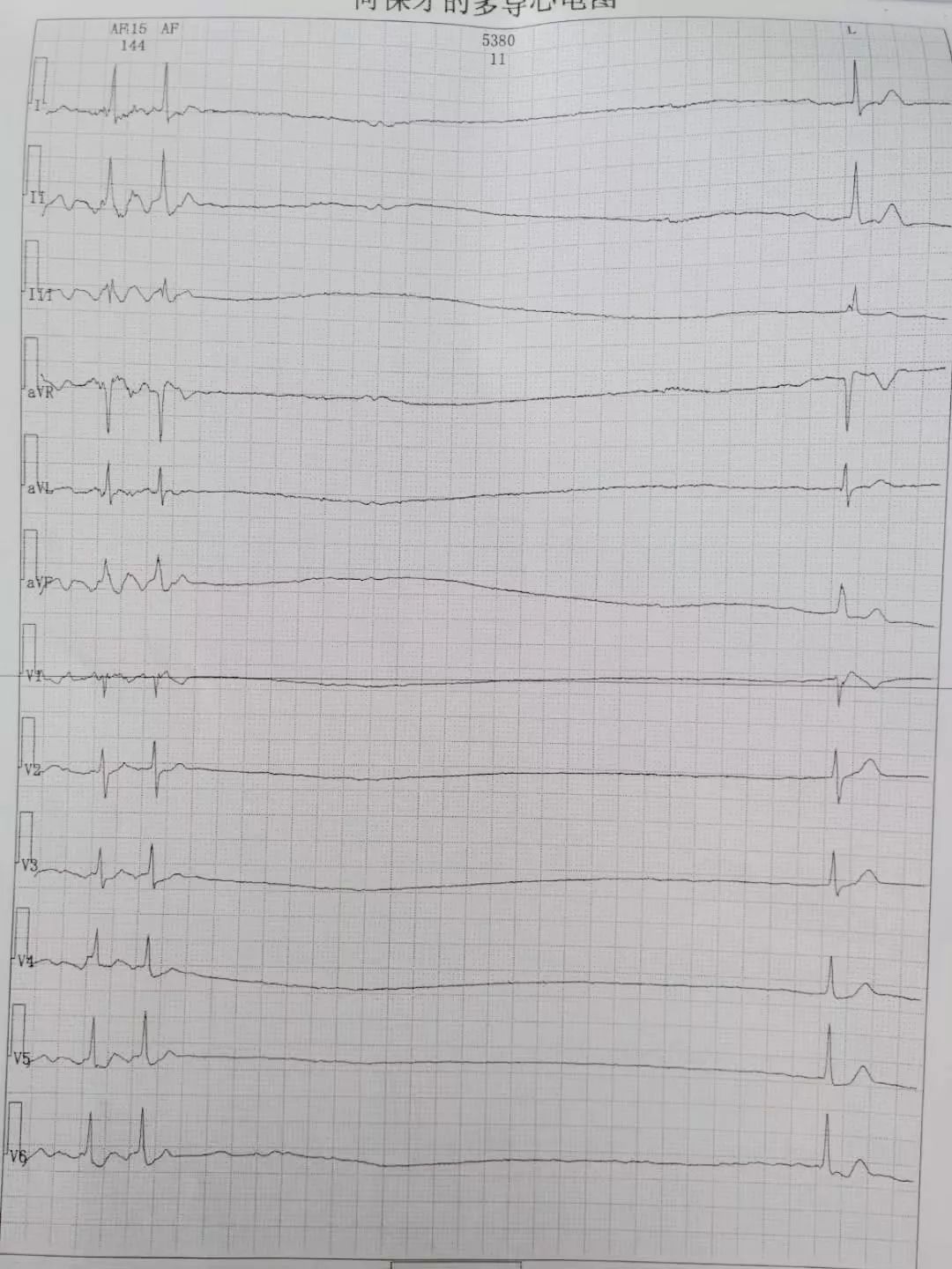 一个月前因再次晕厥颅骨骨折后来到漯河市中心医院,行24小时动态心电