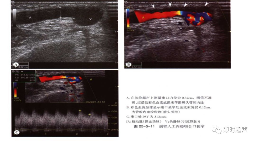 血液透析动静脉造瘘的超声评价