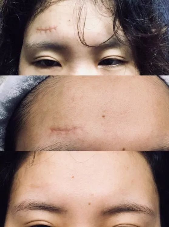 美国祛疤膏,双眼皮开眼角手术,剖腹产,点痣,烧烫疤,刀伤疤,各种手术疤