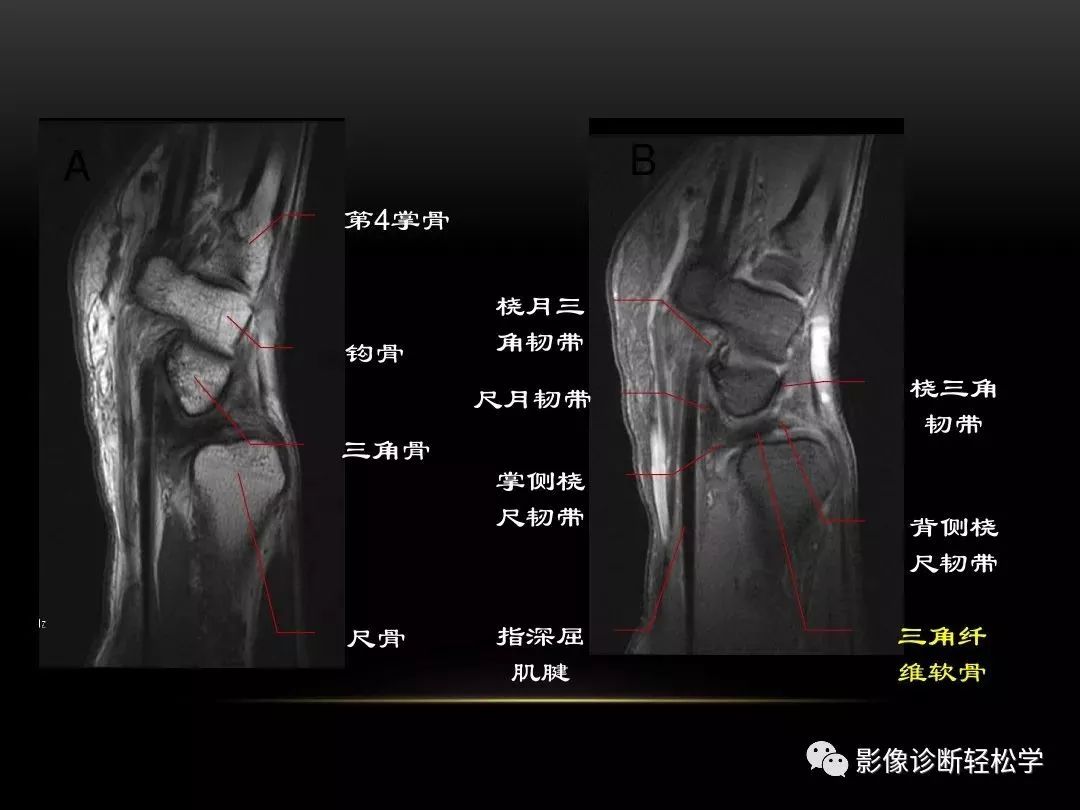 腕关节病变的mri诊断和解剖