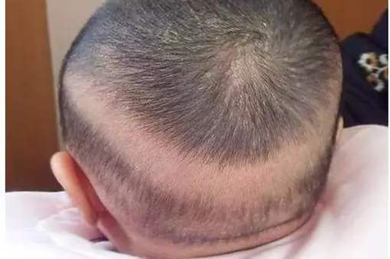 辟谣:宝宝枕秃就是缺钙?怀疑佝偻病?营养