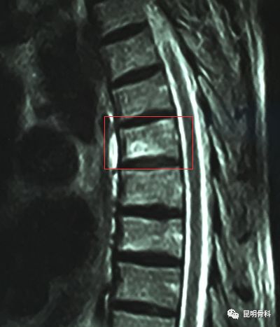 胸6椎体骨折