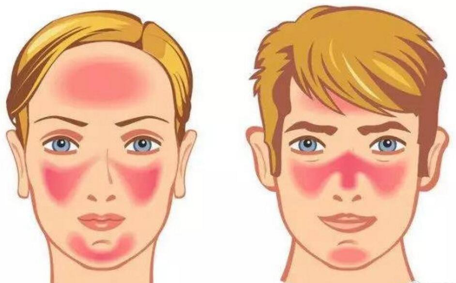 玫瑰痤疮,日常生活中如何护理?