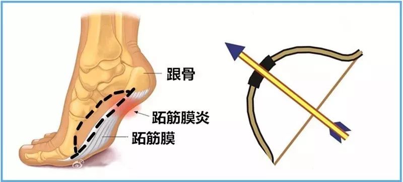 走路脚跟痛,骨刺在作怪?如何来破解?