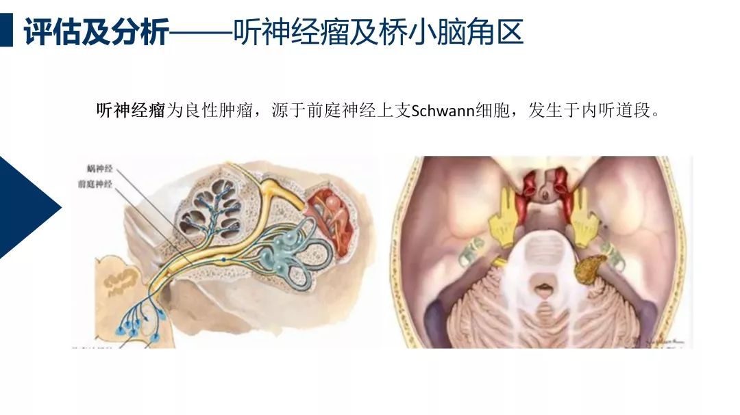 病例分析听神经瘤术后吞咽障碍分析