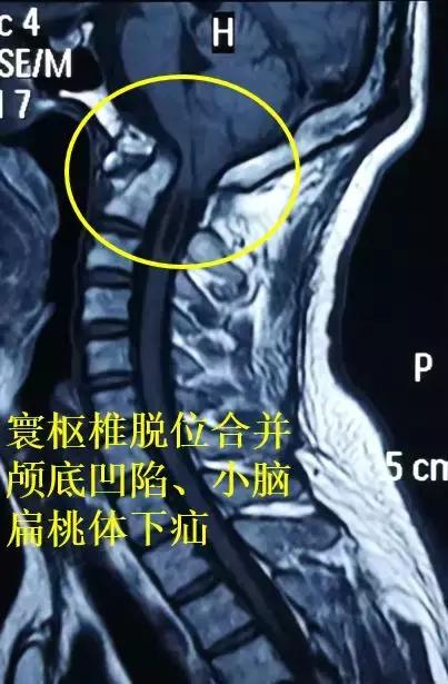 寰枢椎脱位手术常见问题神经外科专家张风江科普系列