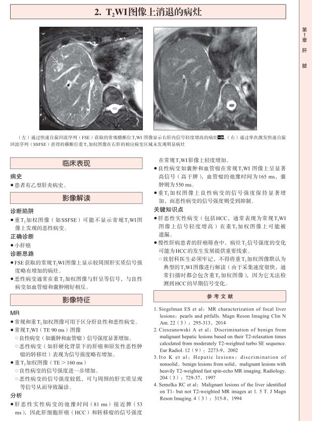 「新书上架」腹盆部影像诊断陷阱与典型征象