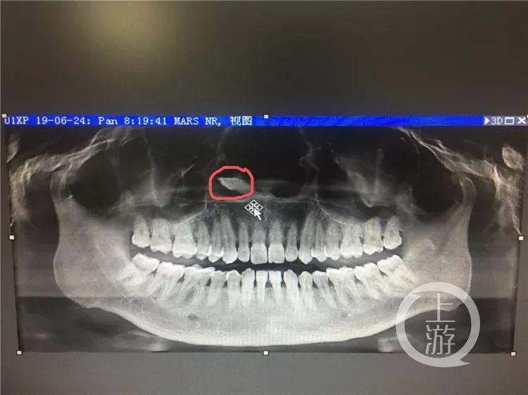 男子鼻腔里长了一颗牙!医生说不稀奇,还有牙齿跑到眼眶下的