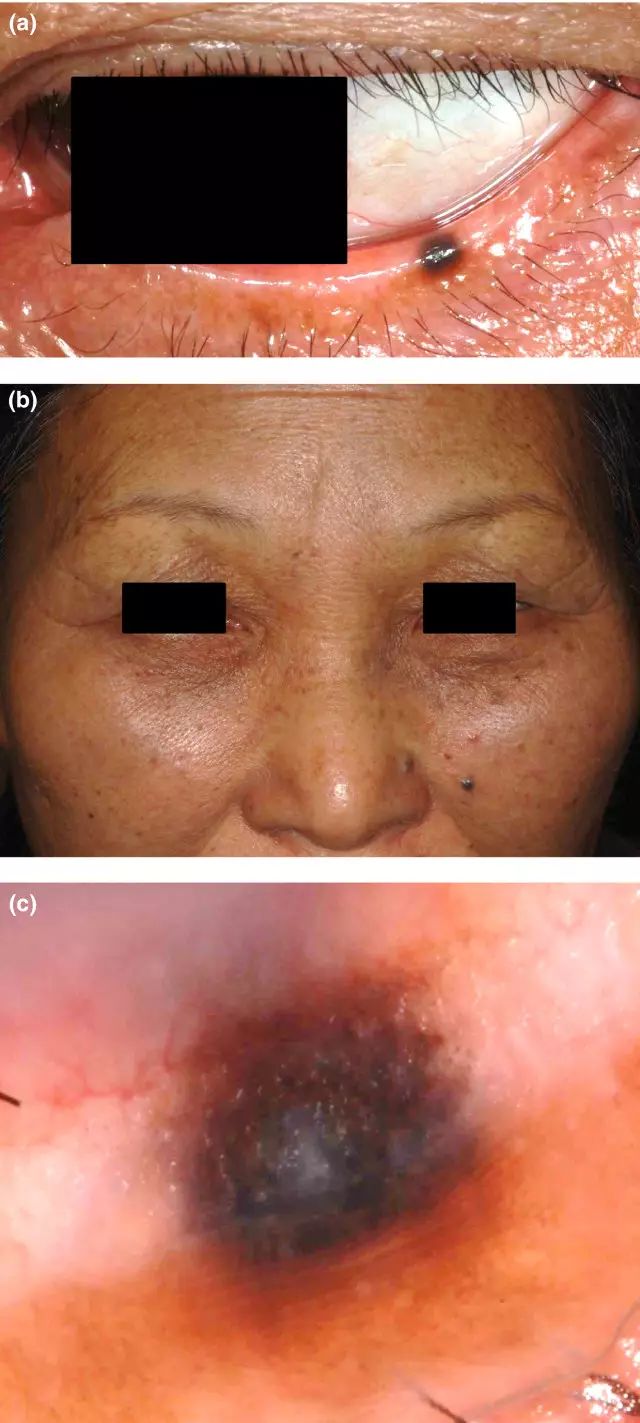 病例学习 这些 痣 的诊断相同么 病理