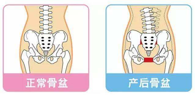 特别是在顺产的时候,骨盆下口扩张会更夸张.一