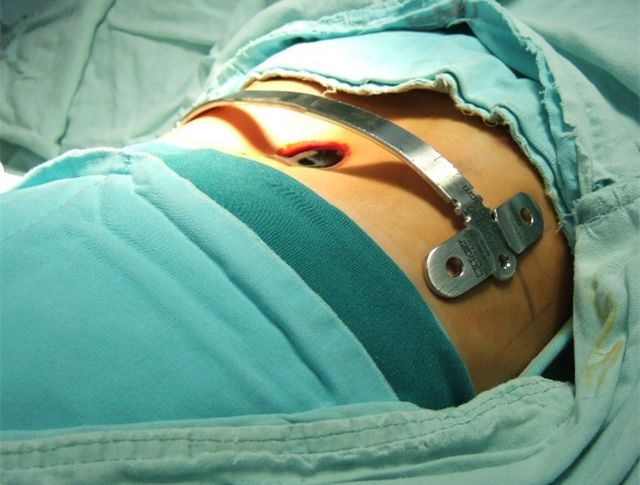 15分钟无管手术100成功率不复发漏斗胸患儿们来了解一下我院胸外科胸