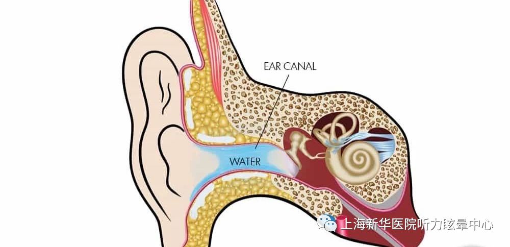 耳朵的水出不来怎么办