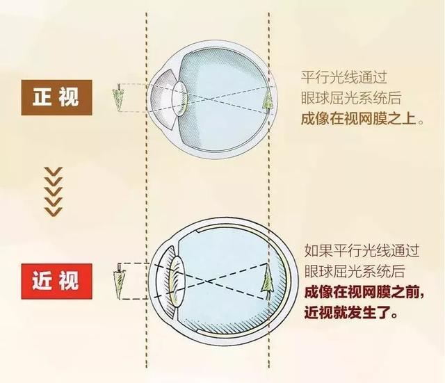 眼科专家谈:孩子近视了到底该怎么办?怎样预防近视发生?