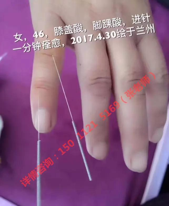 飞虎闪电针纯干货针法分享点进来马上学习