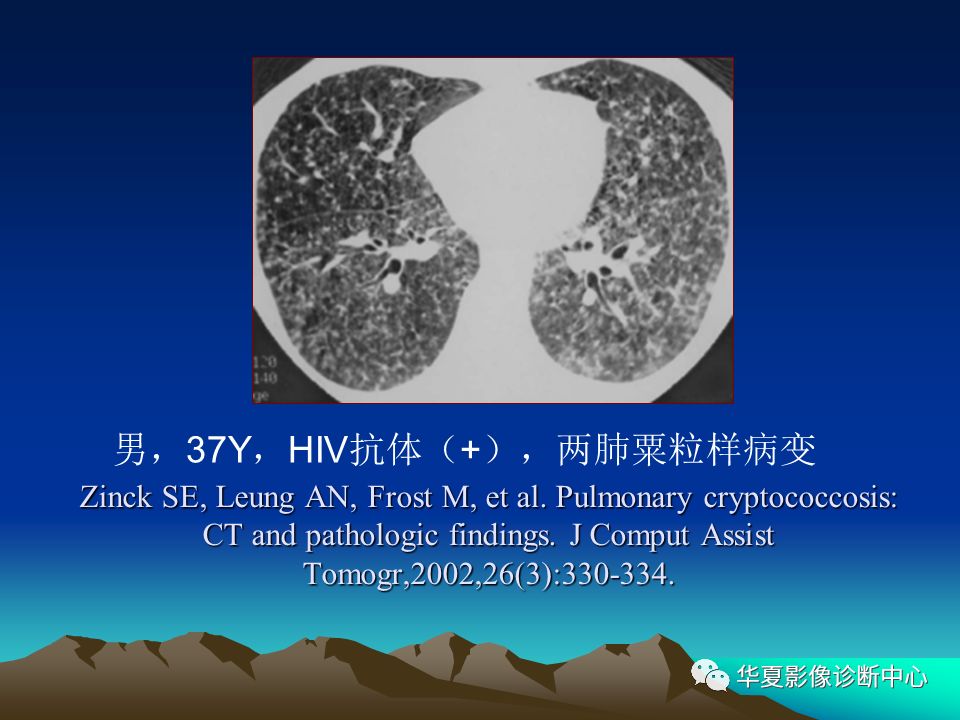 肺隐球菌病的ct诊断分析