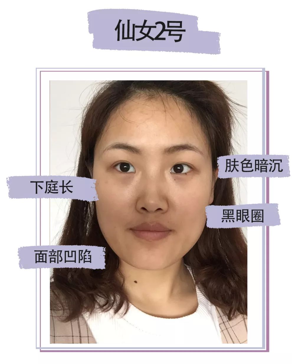 整体分析:面部凹陷,下庭长,肤色暗沉,黑眼圈