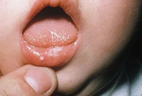                     新生宝宝皮肤护理指南：婴儿湿疹、尿布疹、脂溢性皮炎、热痱等常见皮肤问题的处理方法