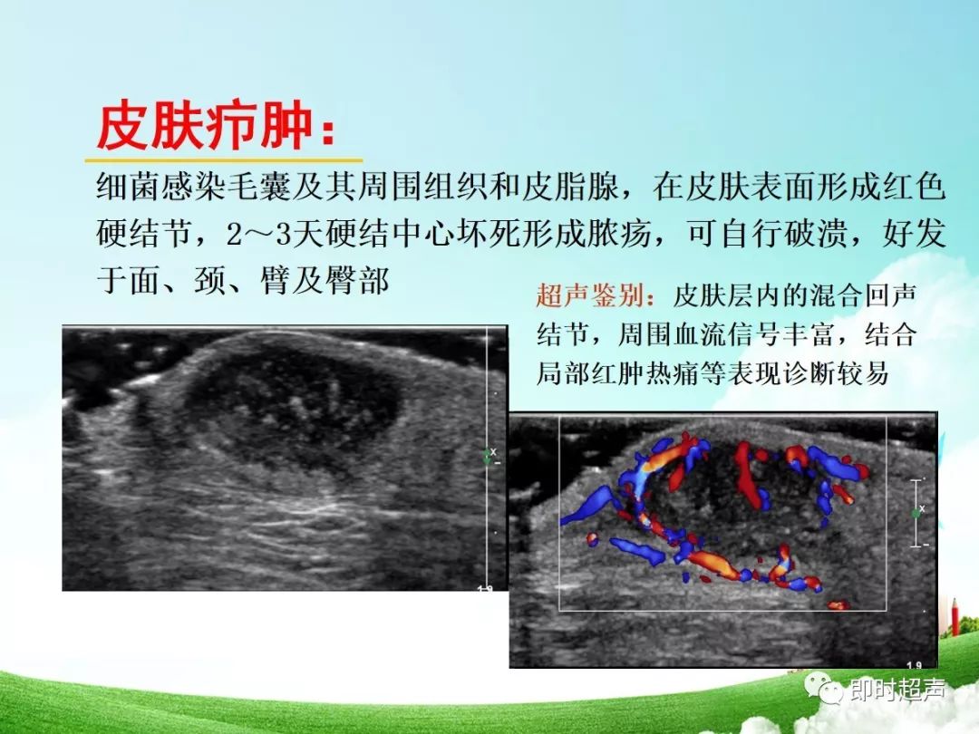 钙化上皮瘤的超声诊断