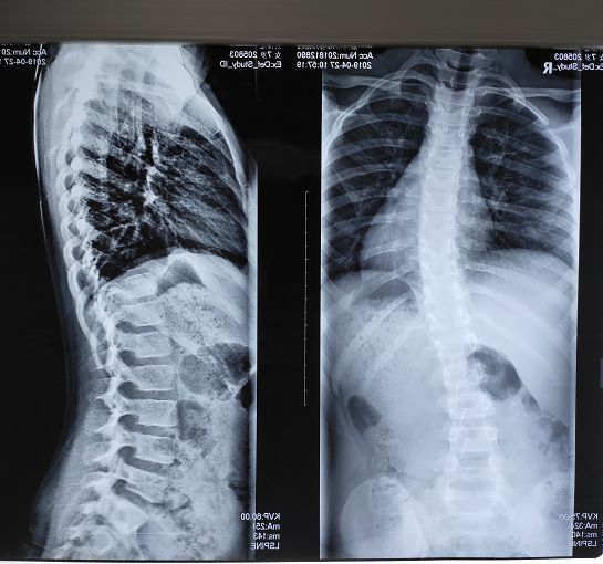 图为小患者们的x光片,可看到他们的脊柱明显侧弯.