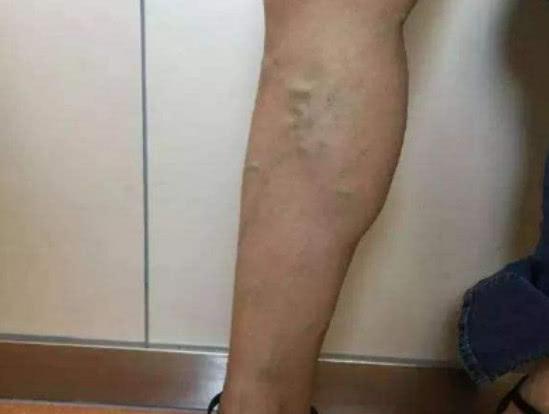 为何怀孕期间,腿上会出现紫色或蓝色的脉络?可能是这种原因导致