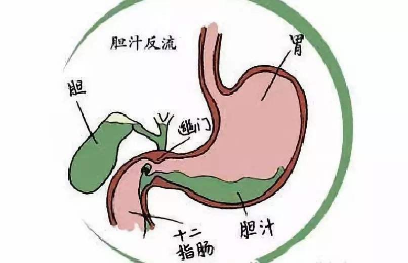 胆汁反流性胃炎是一种很常见的胃病,患者常会出现胸腹部闷,痛,胀的