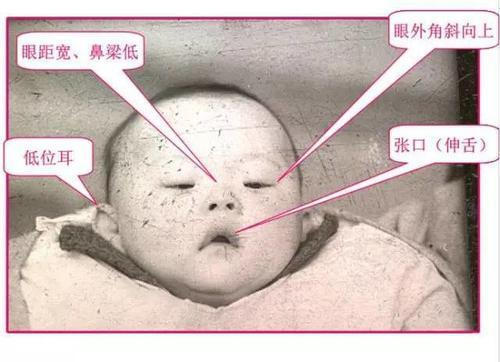 每20分钟就有一个“唐氏儿”出生,医生:这类孕妈占比例最高 明升88娱乐注册