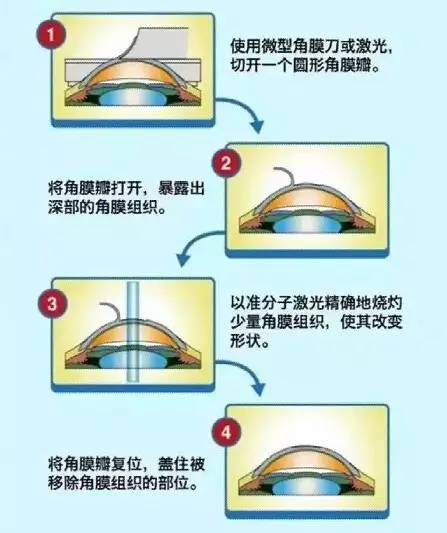 近视手术原理,准分子和飞秒,一句话秒懂!