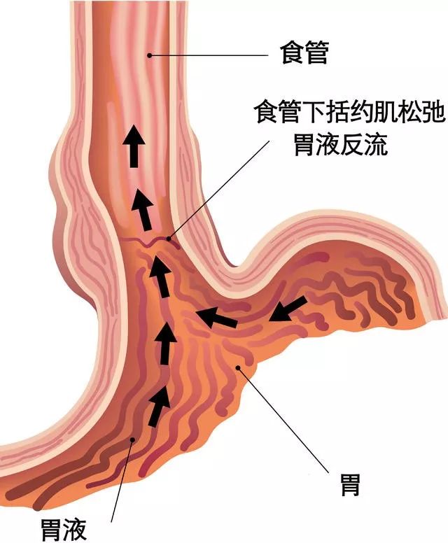 如果食管下括约肌异常舒张,胃酸就会反流到食管中引起烧心.