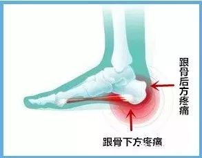 足跟疼痛就是骨刺吗漯河市二院中医针灸理疗科