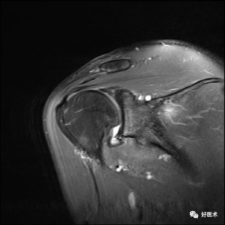 肩关节损伤的影像学诊断技巧看完我就收藏了