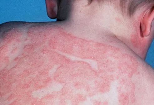                     新生宝宝皮肤护理指南：婴儿湿疹、尿布疹、脂溢性皮炎、热痱等常见皮肤问题的处理方法