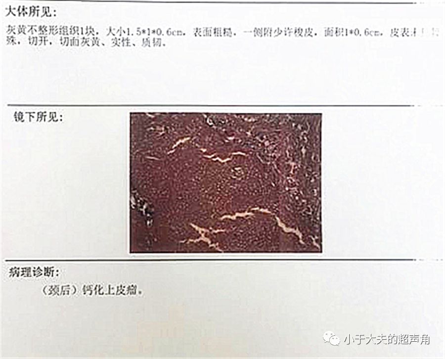 随后,皮肤科给予手术切除, 术后病理回报: 图5:病理回报为钙化上皮瘤