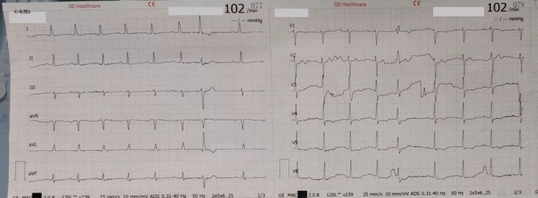 越用药心率越快是怎么回事?