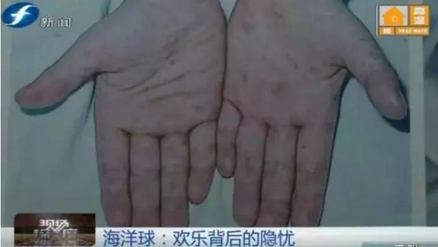                     「手足口病」发病数翻倍！这4个地方是感染重灾区，少带宝宝去！