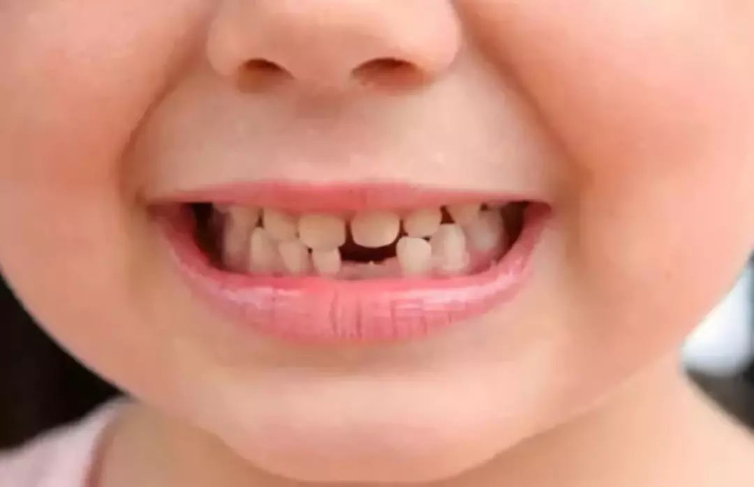 宝宝从不吃糖却满口蛀牙?如何预防蛀牙?
